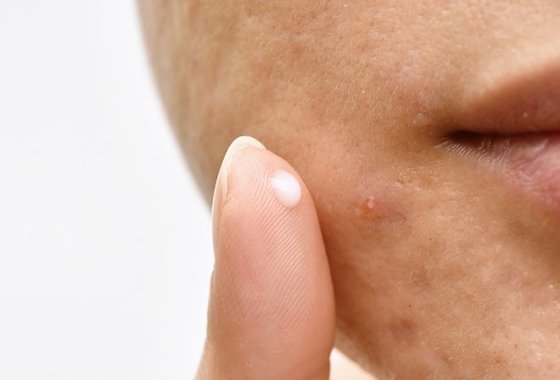 Best Cold Sore Treatments